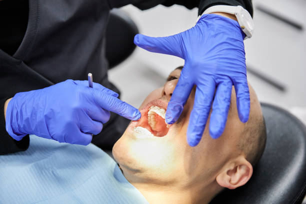 Best Knocked-Out Tooth (Avulsed Tooth) Treatment in Summit, NJ